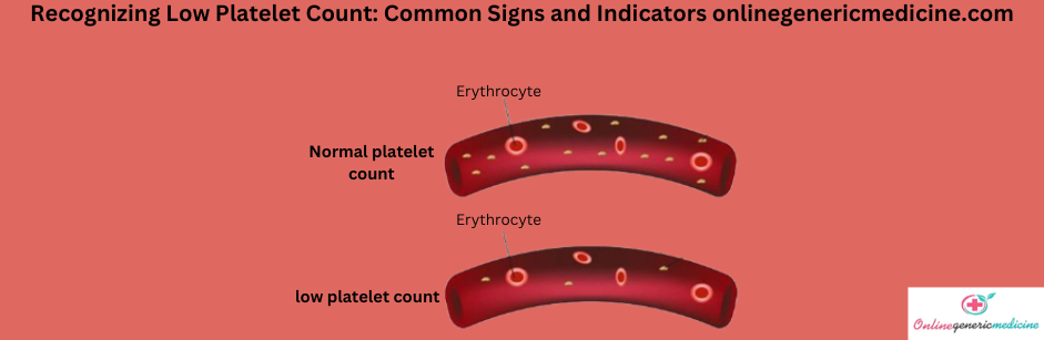 Low platelet count